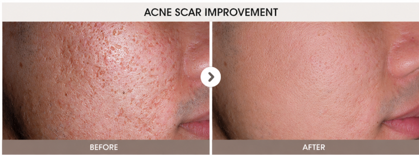 Acne Scars & Skin Texture - Before and After