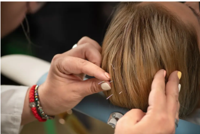 Neuro Acupuncture
