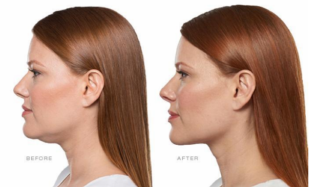Facial Lifting & Contouring - Before and After