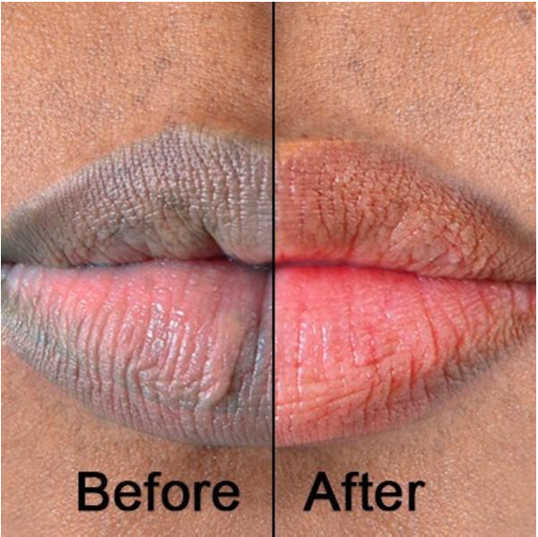 Lip & Facial Tone Enhancement - Before and After
