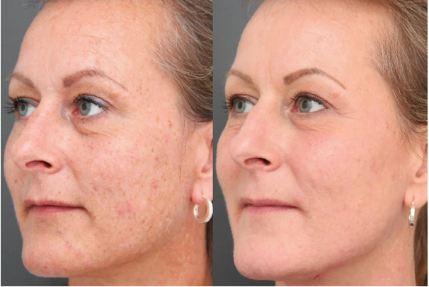 Pigmentation & Uneven Skin Tone - Before and After